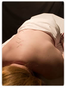    Acupuncture Points   