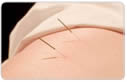    Acupuncture Points   
